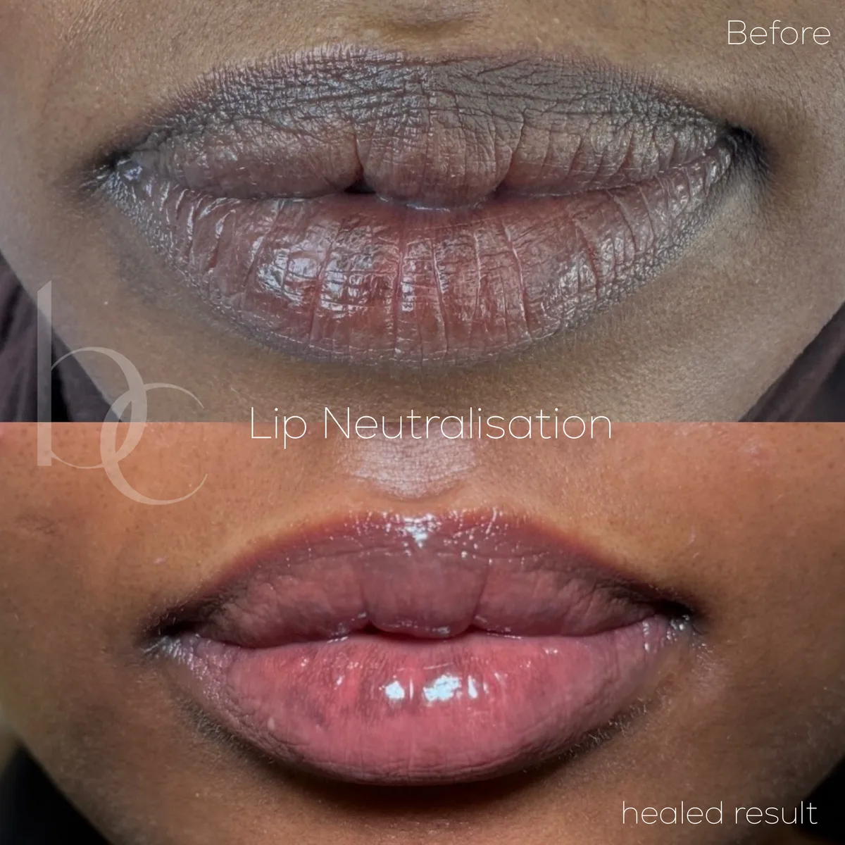 Lip neutralisation before and after, healed result