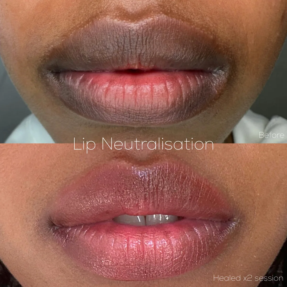 Lip neutralisation healed after two sessions