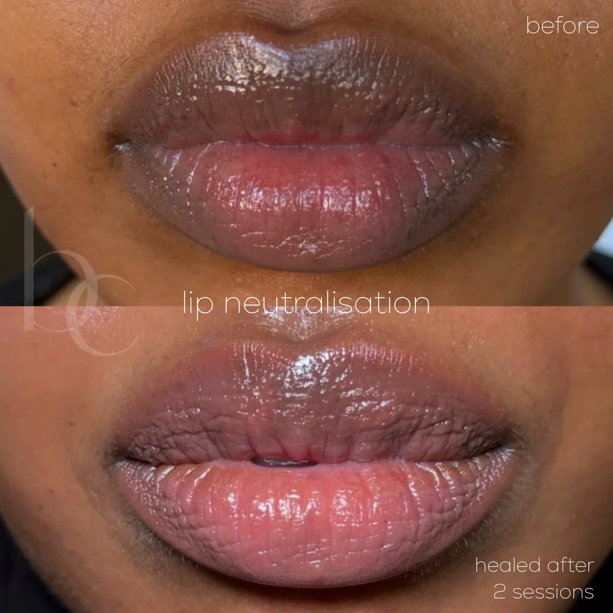 Lip neutralisation healed after two sessions