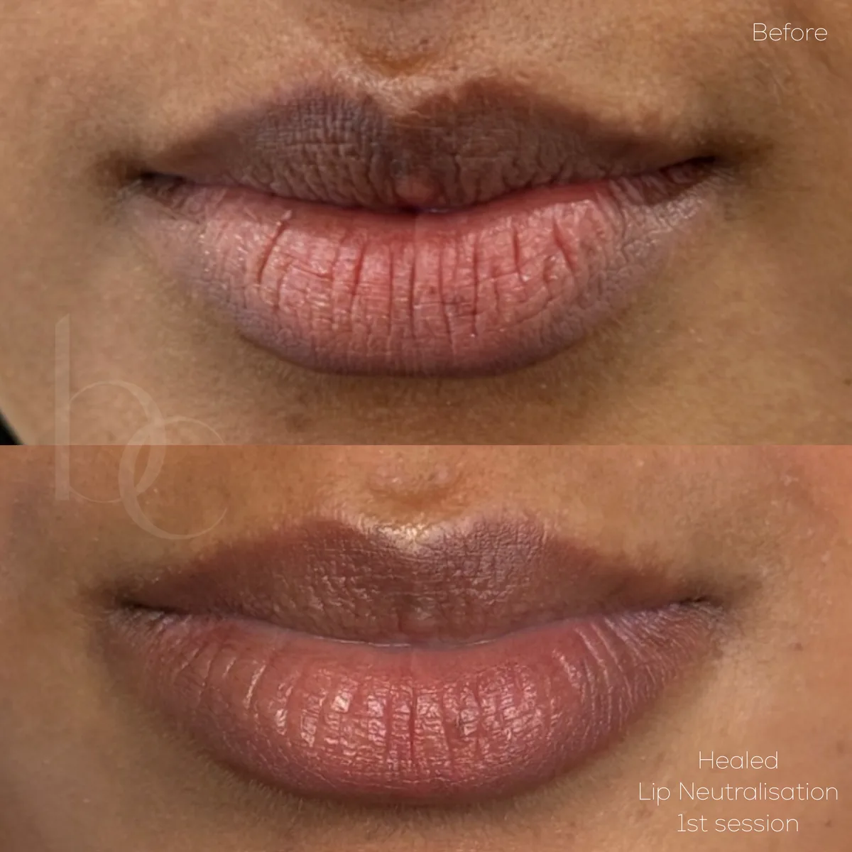 Lip neutralisation healed first session