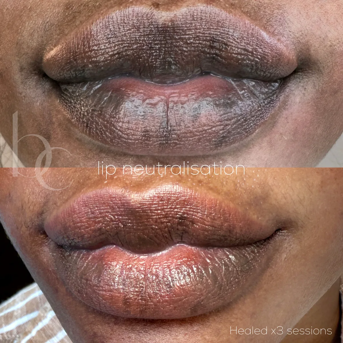 Deep lip neutralisation before and after healed across three sessions