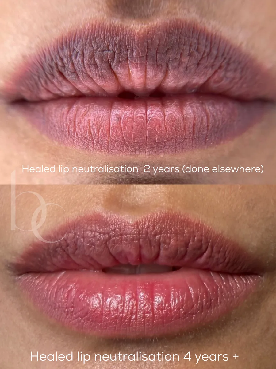 Lip neutralisation healed at four years plus