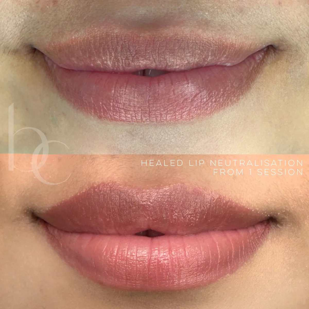 Healed lip neutralisation from one session