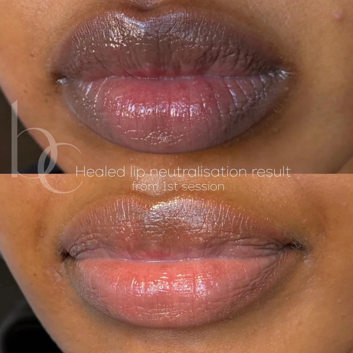 Healed lip neutralisation result from first session