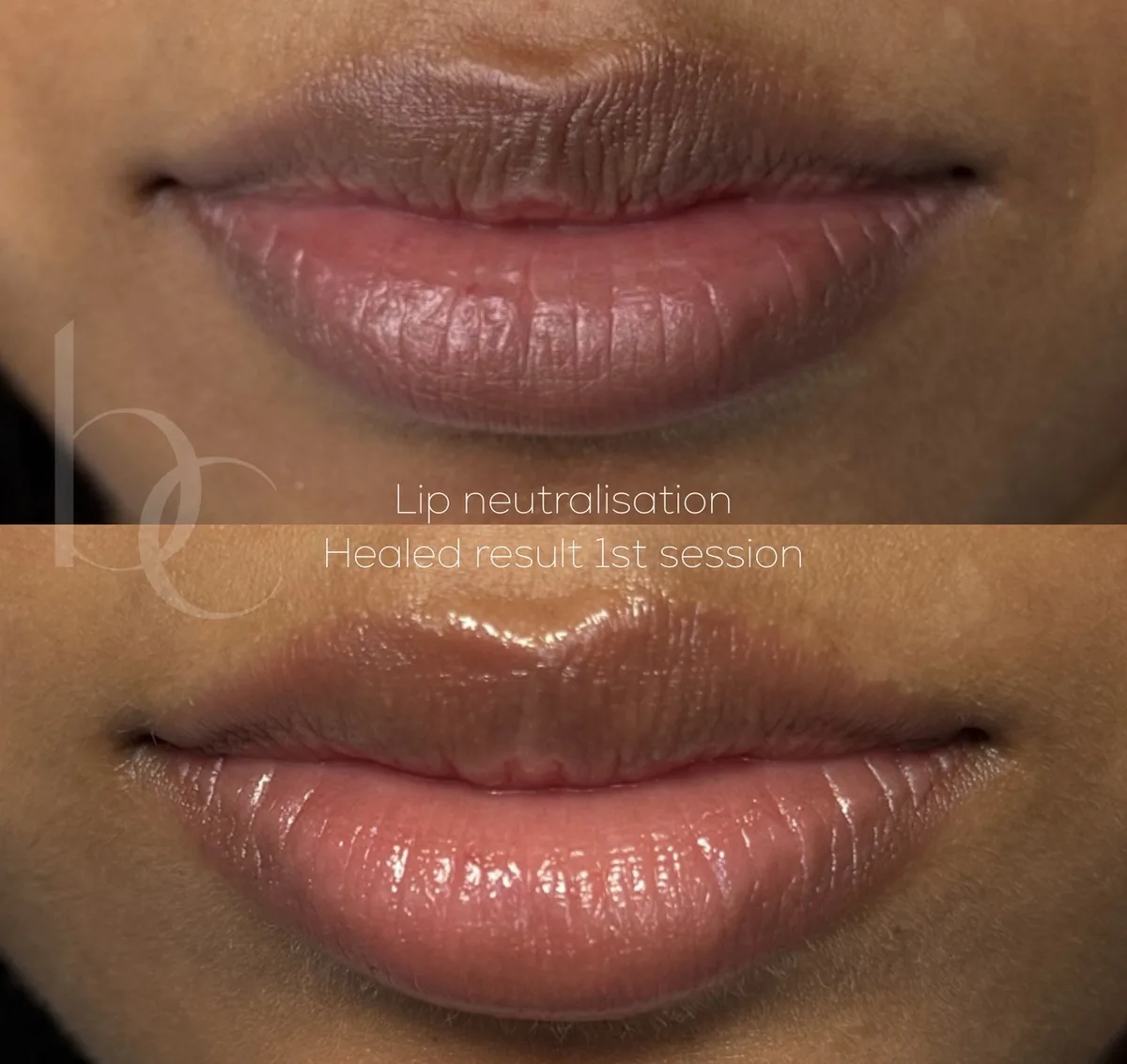 Lip neutralisation healed result first session