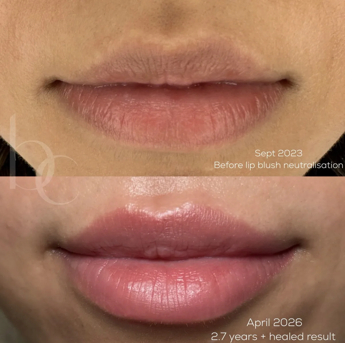 Lip blush neutralisation before and healed two point seven years later