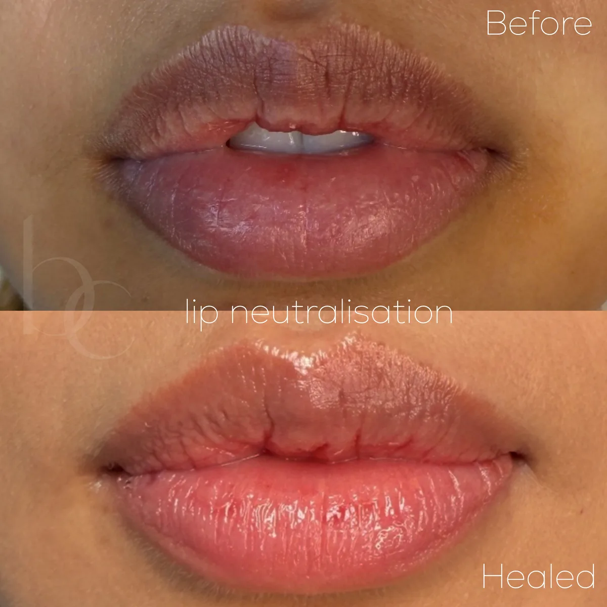 Lip neutralisation before and healed result by Beauty Concierge Melbourne