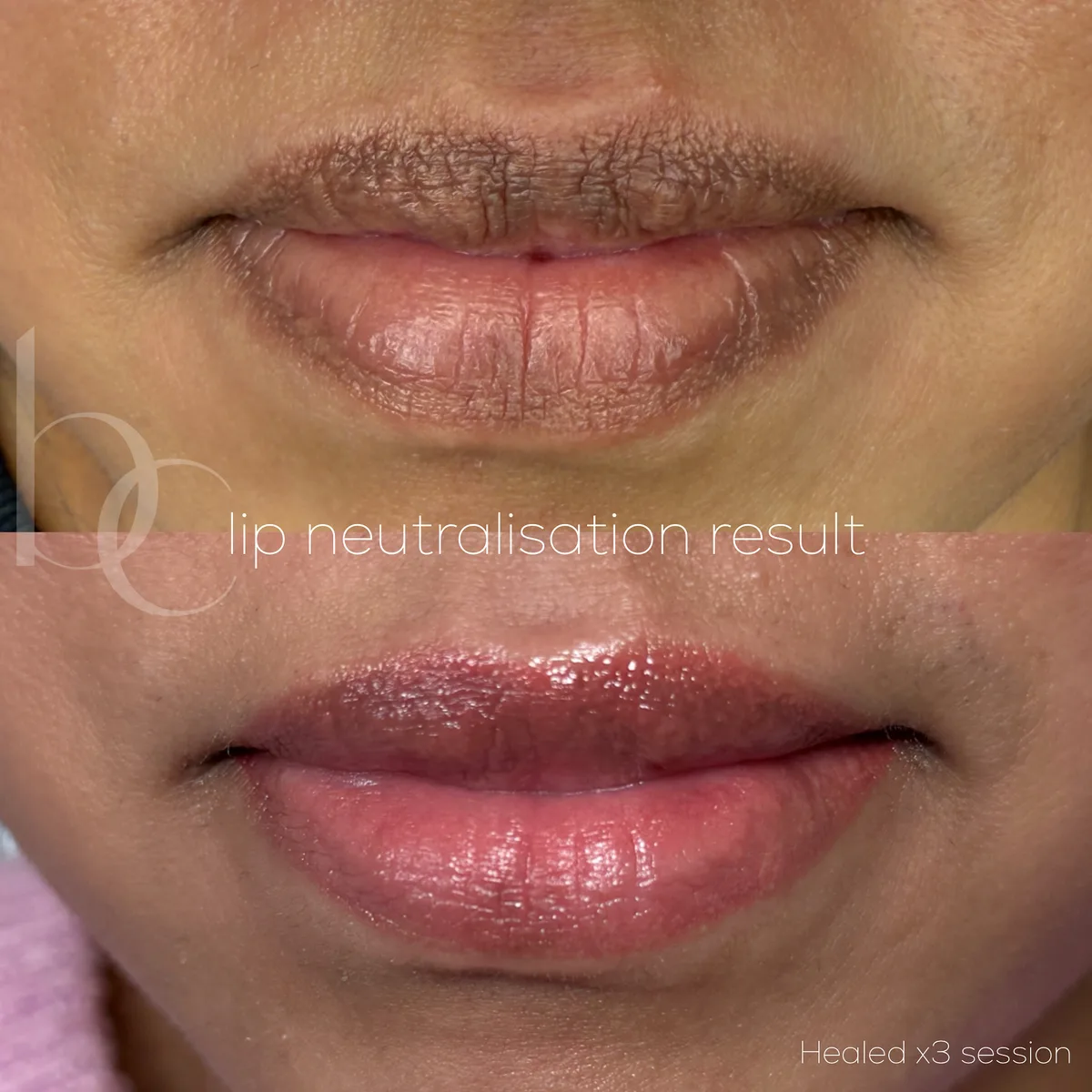 Lip neutralisation healed across three sessions